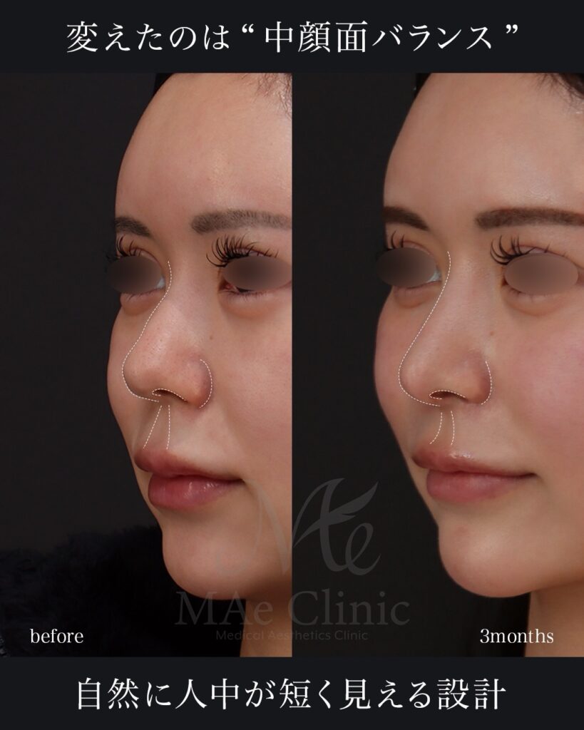 鼻中隔延長（肋軟骨） 鼻尖形成 鼻尖軟骨移植 鼻背細片軟骨移植（隆鼻術） 猫貴族手術（肋軟骨） 鼻翼縮小（内側） 前田翔医師症例