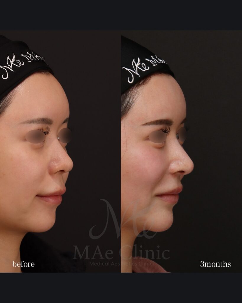 鼻中隔延長（肋軟骨） 鼻尖形成 鼻尖軟骨移植 鼻背細片軟骨移植（隆鼻術） 猫貴族手術（肋軟骨） 鼻翼縮小（内側） 前田翔医師症例