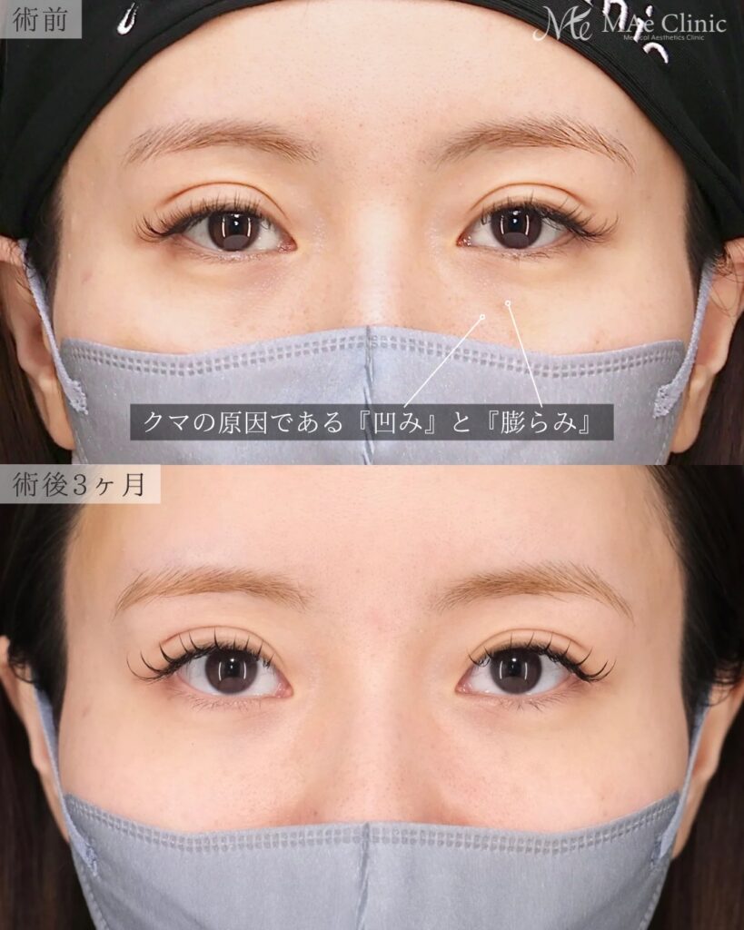 裏ハムラ法 前之園健太医師症例