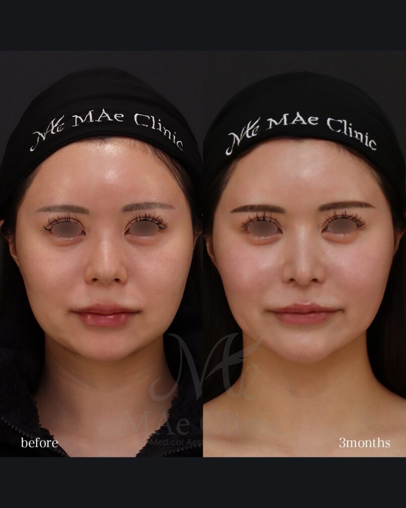 鼻中隔延長（肋軟骨） 鼻尖形成 鼻尖軟骨移植 鼻背細片軟骨移植（隆鼻術） 猫貴族手術（肋軟骨） 鼻翼縮小（内側） 前田翔医師症例