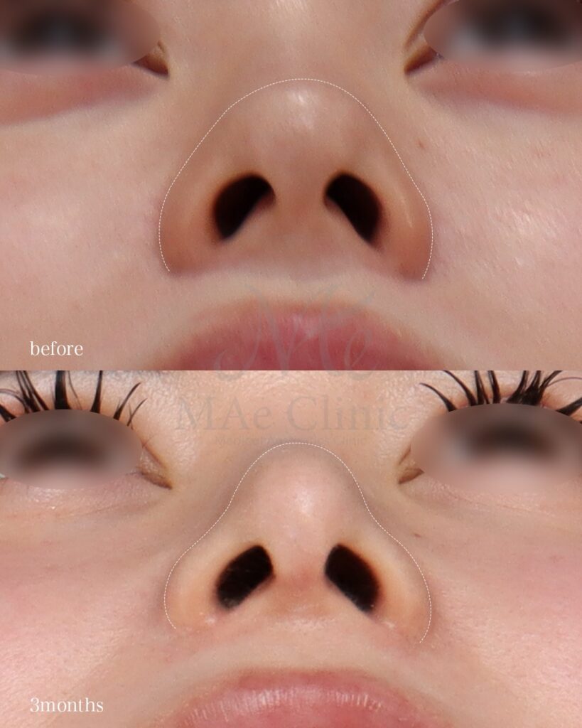 鼻中隔延長（肋軟骨） 鼻尖形成 鼻尖軟骨移植 鼻背細片軟骨移植（隆鼻術） 猫貴族手術（肋軟骨） 鼻翼縮小（内側） 前田翔医師症例