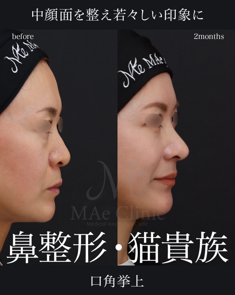 鼻中隔延長（肋軟骨） 鼻尖形成 鼻尖軟骨移植 猫貴族手術 口角挙上 前田翔医師症例