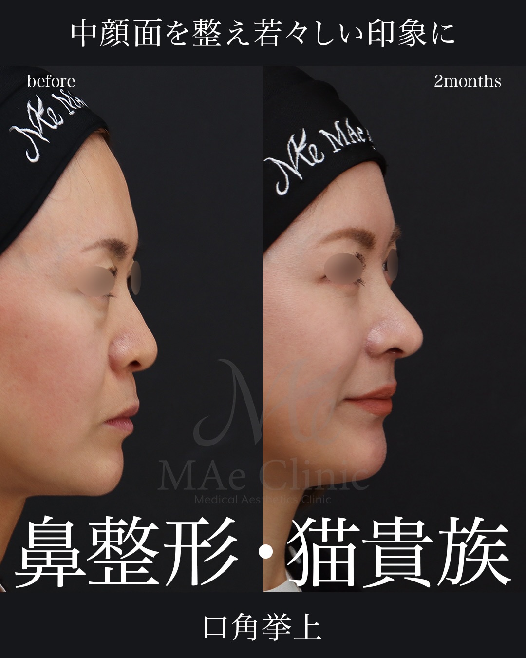 鼻形成術 = Aesthetic Rhinoplasty : 美容外科手術手技 2026031823.jpg