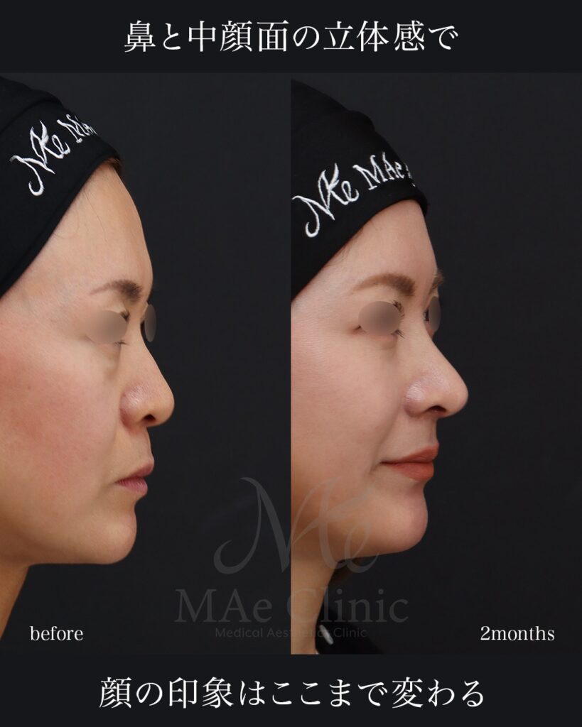 鼻中隔延長（肋軟骨） 鼻尖形成 鼻尖軟骨移植 猫貴族手術 口角挙上 前田翔医師症例