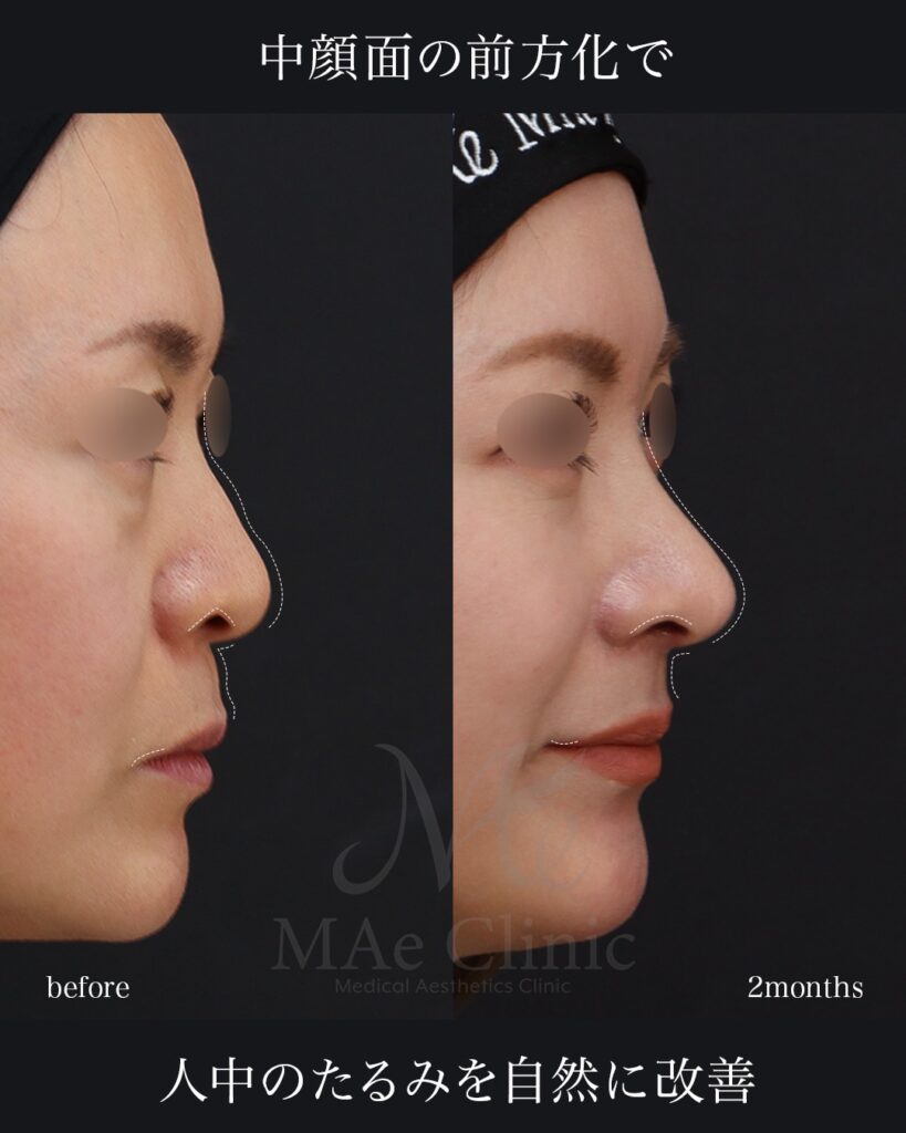 鼻中隔延長（肋軟骨） 鼻尖形成 鼻尖軟骨移植 猫貴族手術 口角挙上 前田翔医師症例