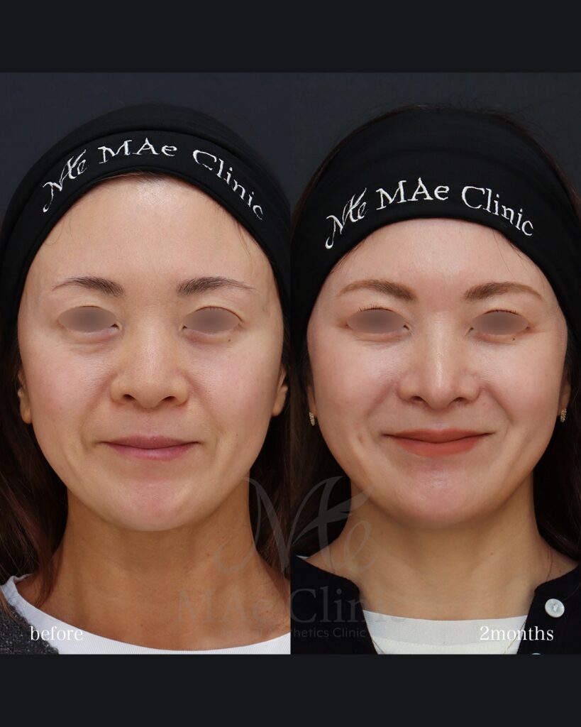 鼻中隔延長（肋軟骨） 鼻尖形成 鼻尖軟骨移植 猫貴族手術 口角挙上 前田翔医師症例