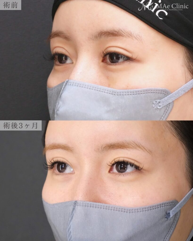 裏ハムラ法 前之園健太医師症例