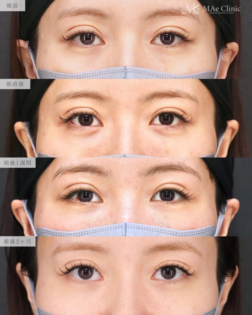 裏ハムラ法 前之園健太医師症例