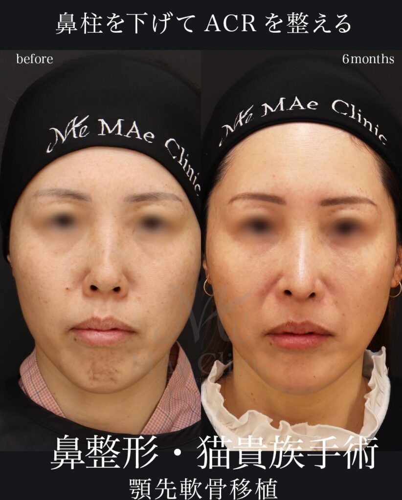 鼻中隔延長(肋軟骨)
鼻尖形成
鼻尖軟骨移植
自家組織隆鼻
猫貴族手術(肋軟骨)
顎先軟骨移植(肋軟骨)望月正人医師症例