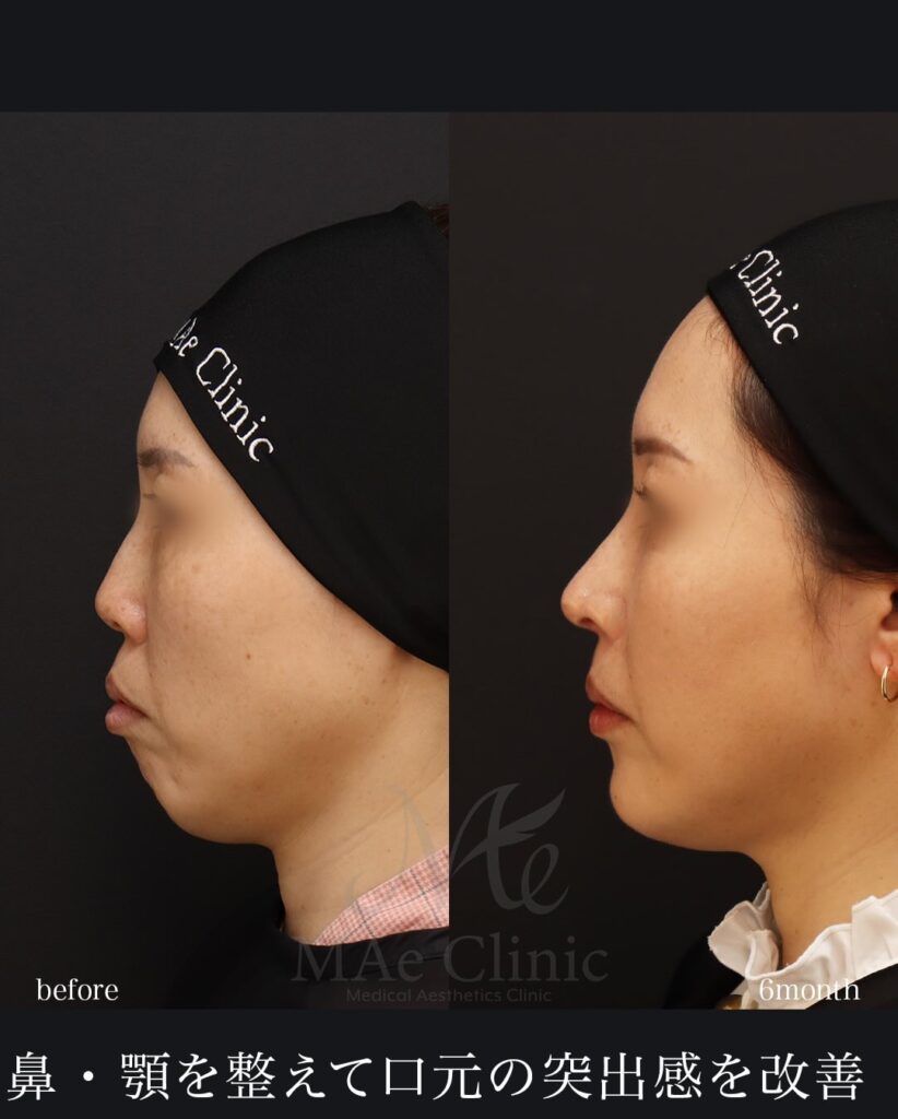 鼻中隔延長(肋軟骨) 鼻尖形成 鼻尖軟骨移植 自家組織隆鼻 猫貴族手術(肋軟骨) 顎先軟骨移植(肋軟骨)望月正人医師症例