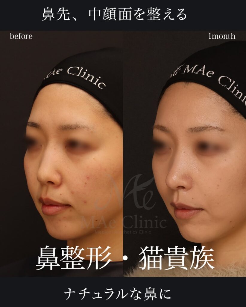 鼻中隔延長(肋軟骨) 鼻尖形成 鼻尖軟骨移植 猫貴族手術(肋軟骨) 望月正人医師症例