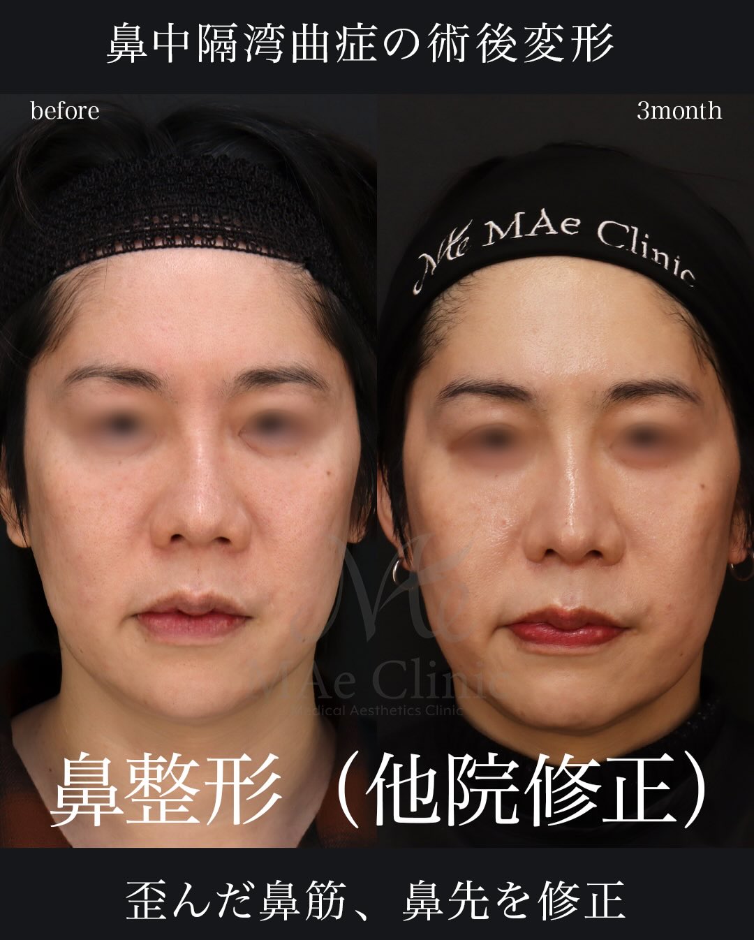鼻中隔湾曲症手術後の変形を肋軟骨で修正した望月正人医師の他院修正
