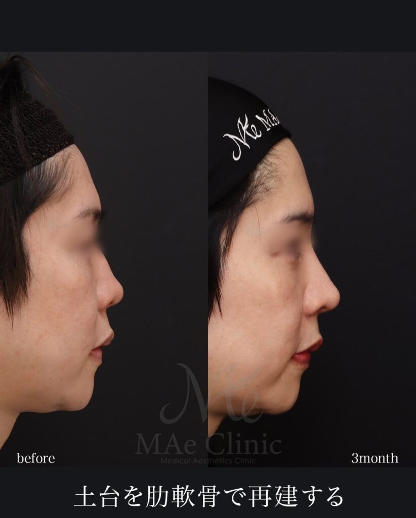 鼻中隔延長(肋軟骨) 鼻尖形成 鼻尖軟骨移植 望月正人医師症例