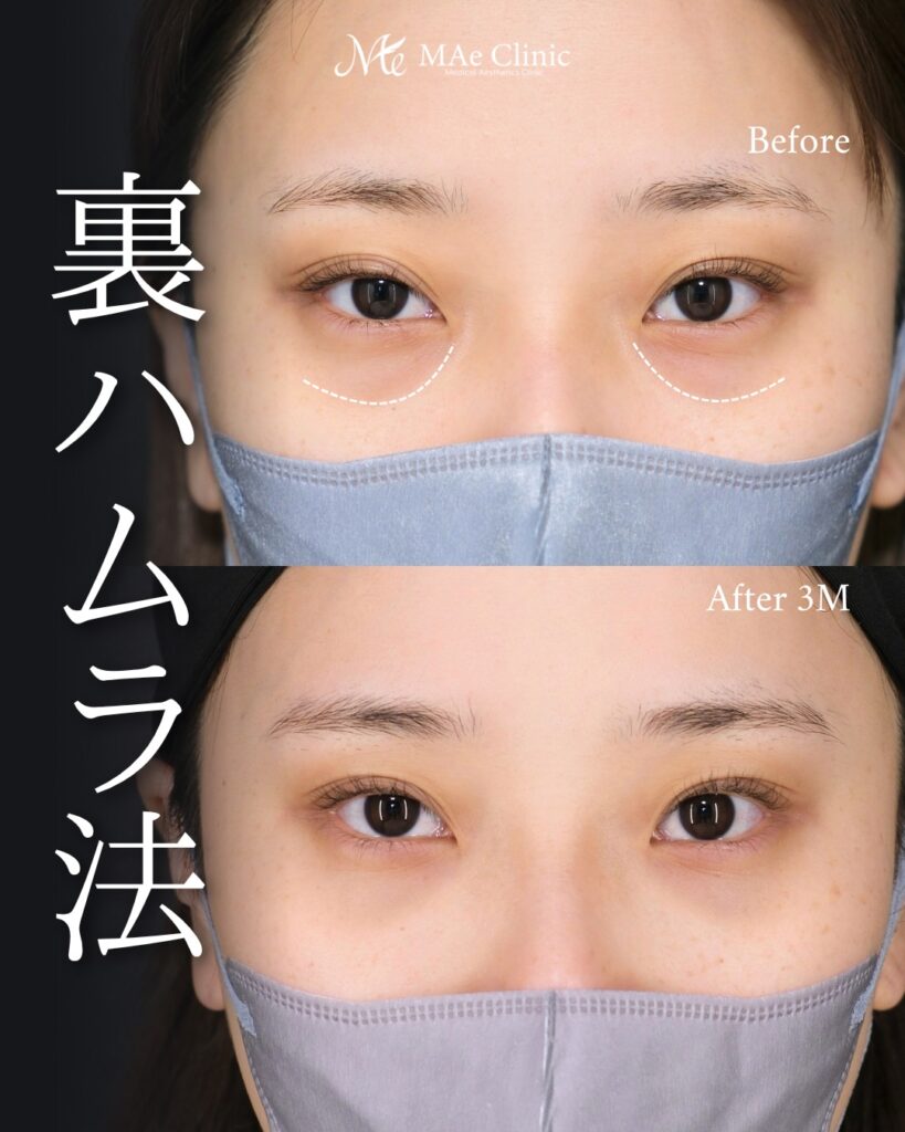 裏ハムラ法 術後3ヵ月 前之園健太医師症例