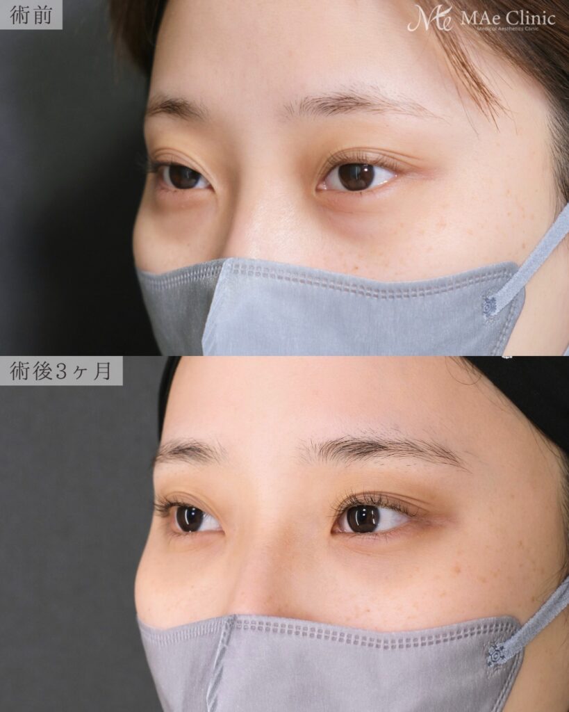 裏ハムラ法 術後3ヵ月 前之園健太医師症例