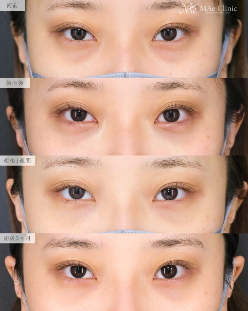 裏ハムラ法 術後3ヵ月 前之園健太医師症例