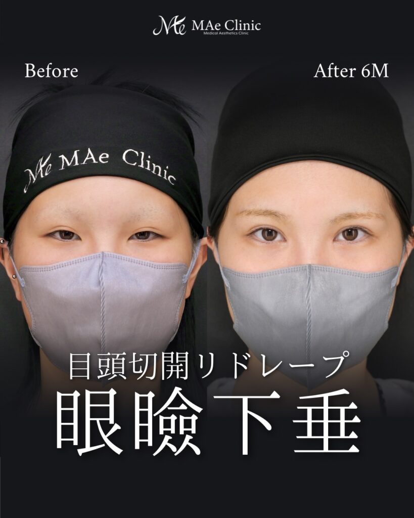 眼瞼下垂手術 目頭切開（リドレープ法） 前之園健太医師症例