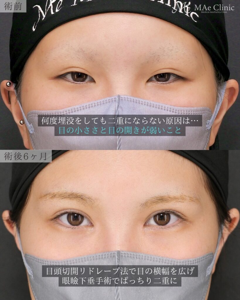 眼瞼下垂手術 目頭切開(リドレープ法) 前之園健太医師症例