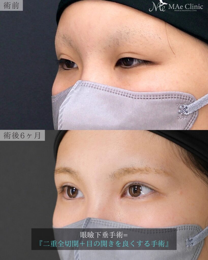 眼瞼下垂手術 目頭切開(リドレープ法) 前之園健太医師症例