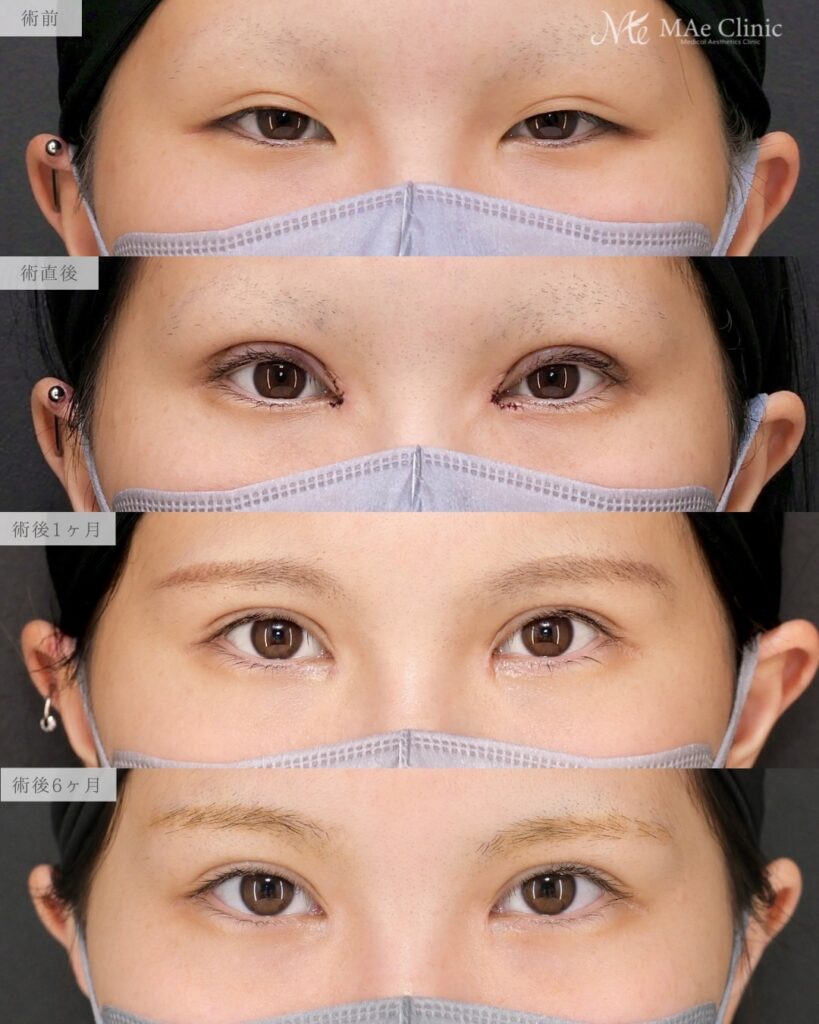 眼瞼下垂手術 目頭切開(リドレープ法) 前之園健太医師症例