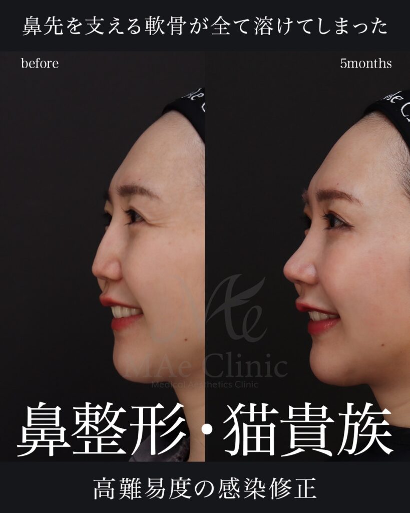 鼻中隔延長(肋軟骨)
鼻尖形成
鼻尖軟骨移植
隆鼻(肋軟骨)
猫貴族手術(肋軟骨)
前田翔医師症例