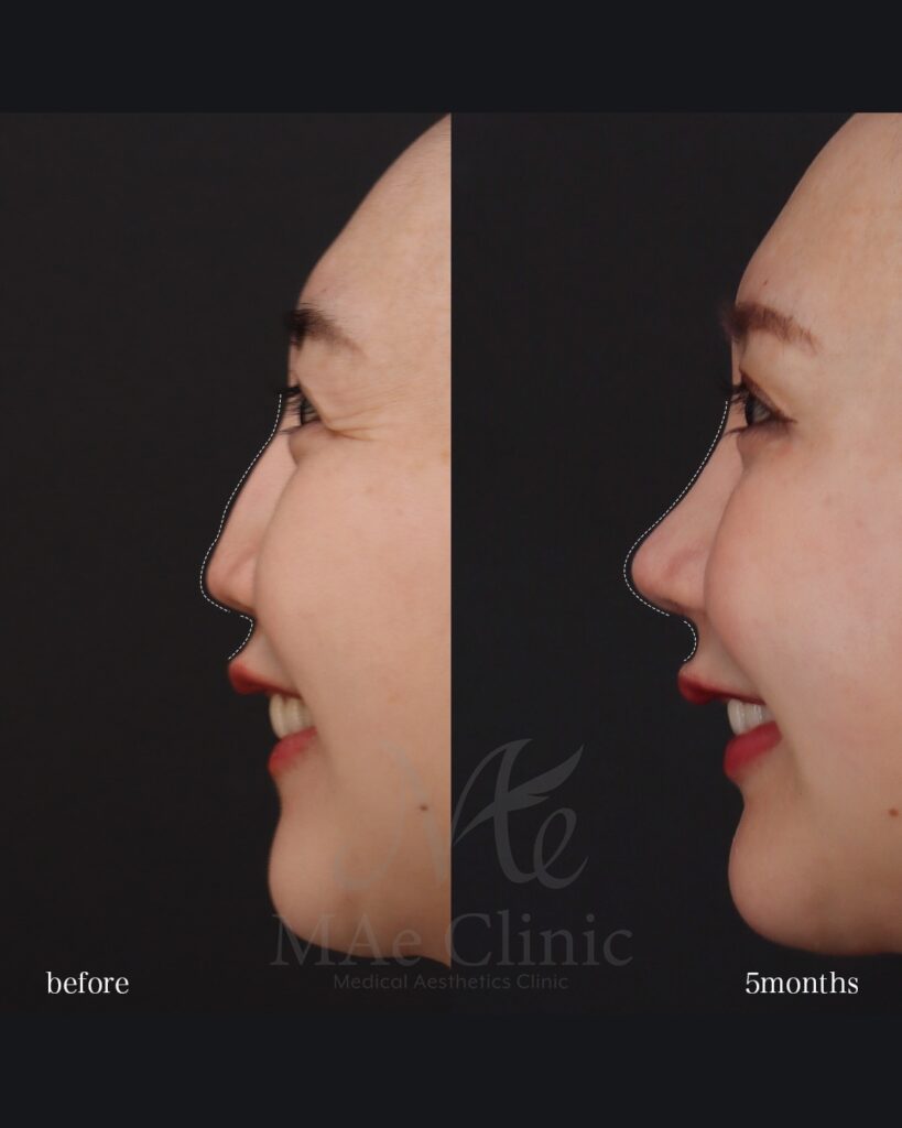 鼻中隔延長(肋軟骨) 鼻尖形成 鼻尖軟骨移植 隆鼻(肋軟骨) 猫貴族手術(肋軟骨) 前田翔医師症例