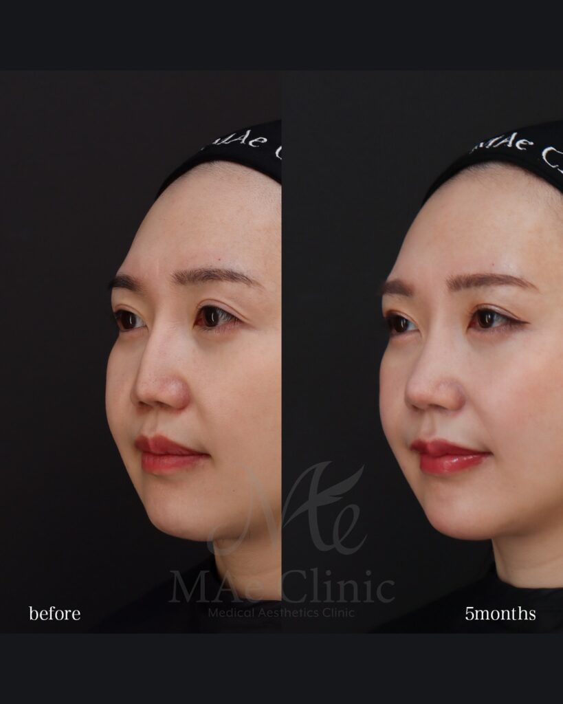 鼻中隔延長(肋軟骨) 鼻尖形成 鼻尖軟骨移植 隆鼻(肋軟骨) 猫貴族手術(肋軟骨) 前田翔医師症例