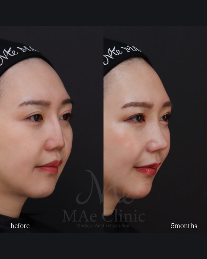 鼻中隔延長(肋軟骨) 鼻尖形成 鼻尖軟骨移植 隆鼻(肋軟骨) 猫貴族手術(肋軟骨) 前田翔医師症例