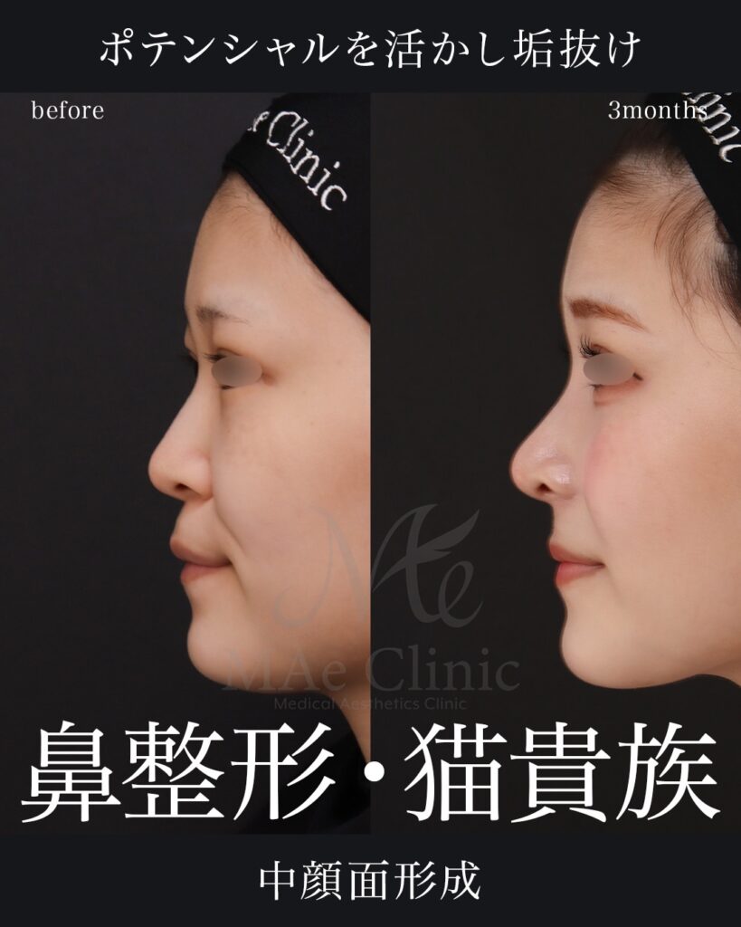 鼻中隔延長(肋軟骨) 鼻尖形成 鼻尖軟骨移植 隆鼻(肋軟骨) 鼻翼縮小(内側) 猫貴族手術(肋軟骨) 前田翔医師症例