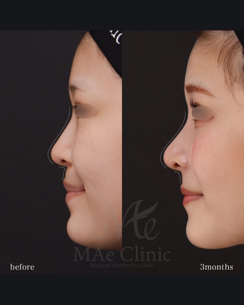 鼻中隔延長(肋軟骨) 鼻尖形成 鼻尖軟骨移植 隆鼻(肋軟骨) 鼻翼縮小(内側) 猫貴族手術(肋軟骨) 前田翔医師症例