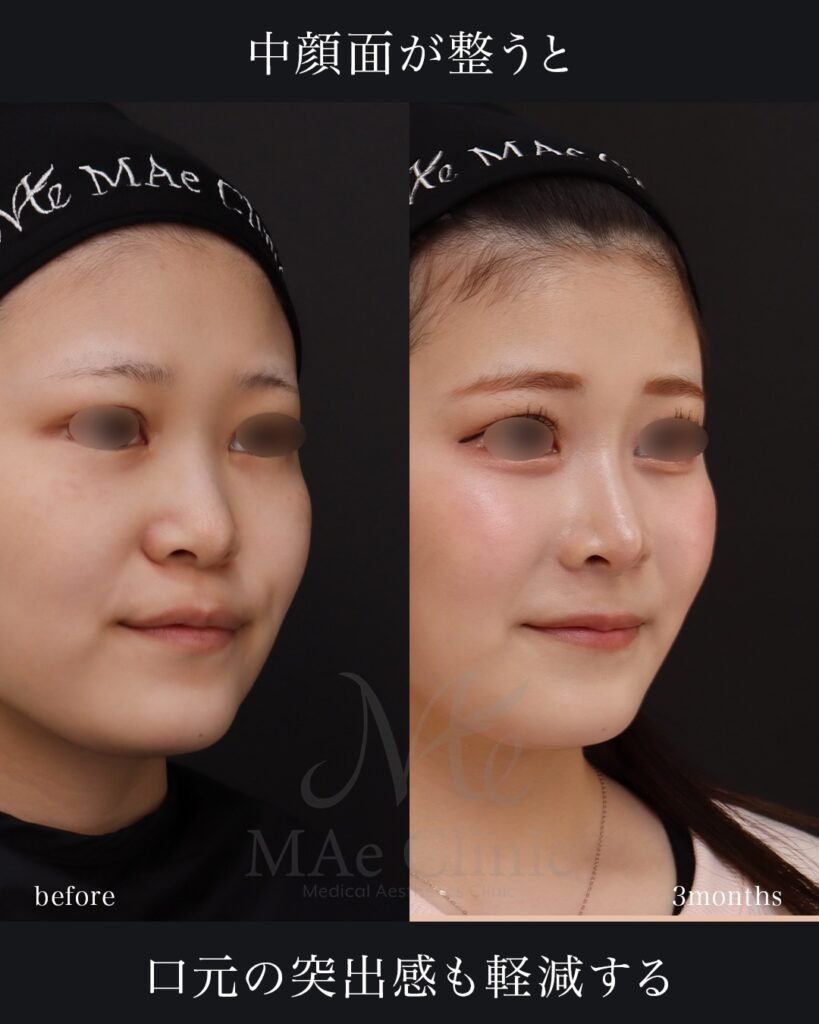 鼻中隔延長(肋軟骨) 鼻尖形成 鼻尖軟骨移植 隆鼻(肋軟骨) 鼻翼縮小(内側) 猫貴族手術(肋軟骨) 前田翔医師症例