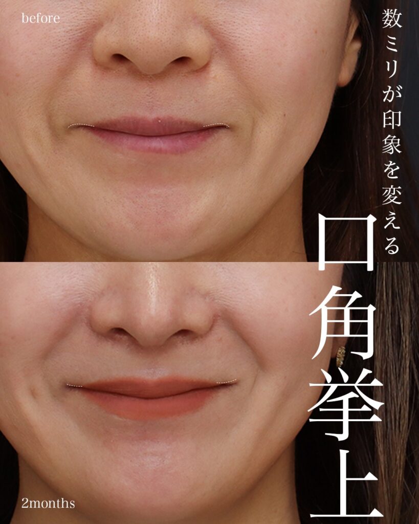 口角挙上 鼻中隔延長（肋軟骨） 鼻尖形成 鼻尖軟骨移植 猫貴族手術（肋軟骨） 前田翔医師症例