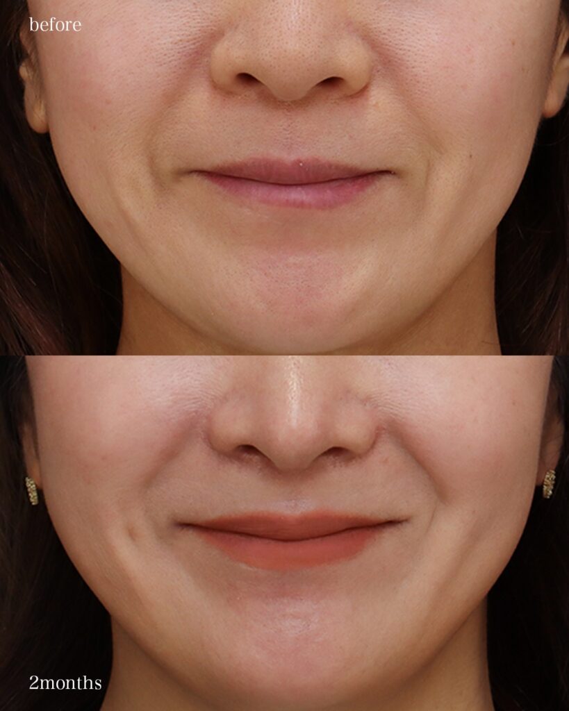 口角挙上 鼻中隔延長（肋軟骨） 鼻尖形成 鼻尖軟骨移植 猫貴族手術（肋軟骨） 前田翔医師症例