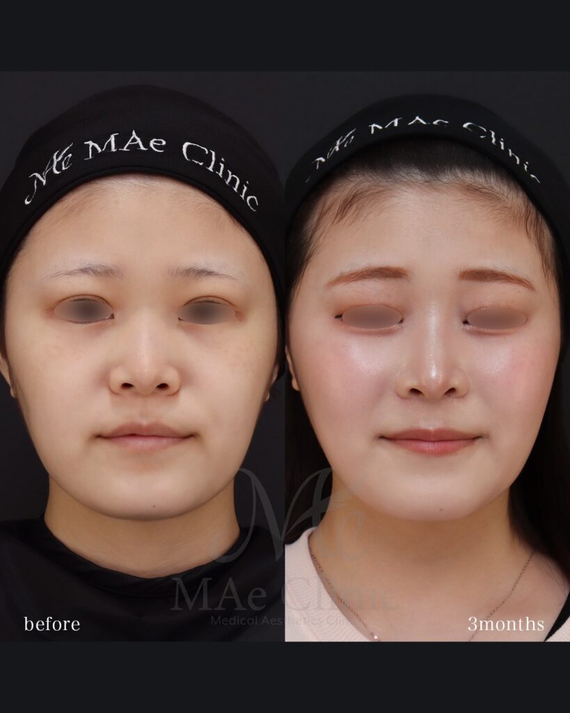 鼻中隔延長(肋軟骨) 鼻尖形成 鼻尖軟骨移植 隆鼻(肋軟骨) 鼻翼縮小(内側) 猫貴族手術(肋軟骨) 前田翔医師症例