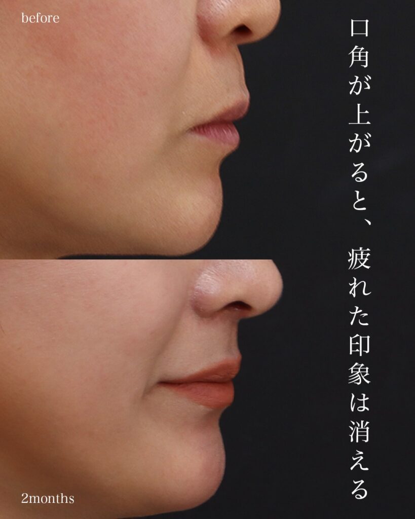 口角挙上 鼻中隔延長（肋軟骨） 鼻尖形成 鼻尖軟骨移植 猫貴族手術（肋軟骨） 前田翔医師症例