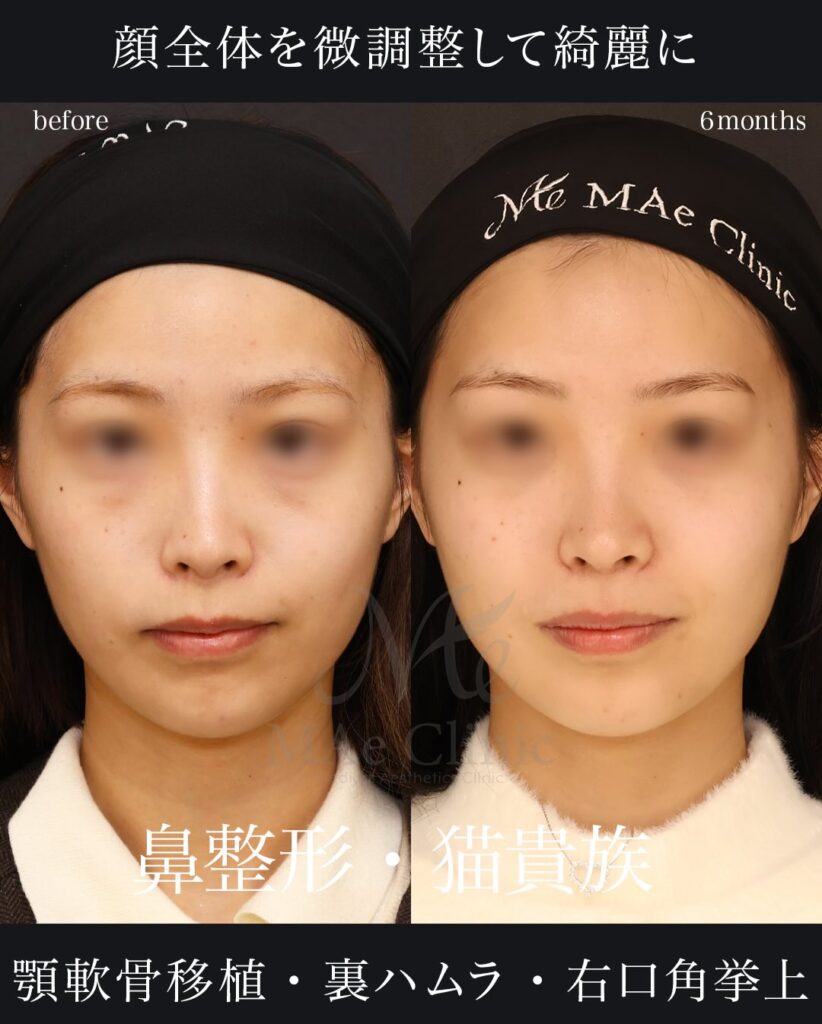 鼻中隔延長（肋軟骨） 鼻尖形成 鼻尖軟骨移植 猫貴族手術（肋軟骨） 顎先軟骨移植 裏ハムラ法 口角挙上（右） 望月正人医師症例