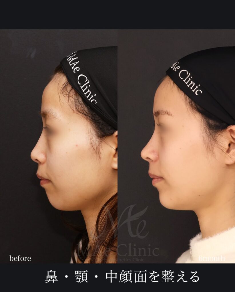 鼻中隔延長(肋軟骨) 鼻尖形成 鼻尖軟骨移植 猫貴族手術(肋軟骨) 顎先軟骨移植 裏ハムラ法 口角挙上(右) 望月正人医師症例