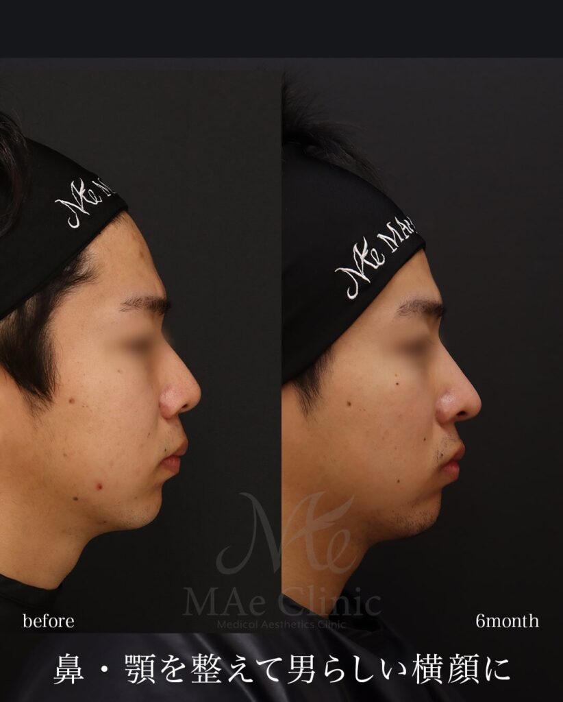 鼻中隔延長（肋軟骨） 鼻尖形成 鼻尖軟骨移植 猫貴族手術（肋軟骨） 顎先軟骨移植（肋軟骨） 自家組織隆鼻 望月正人医師症例