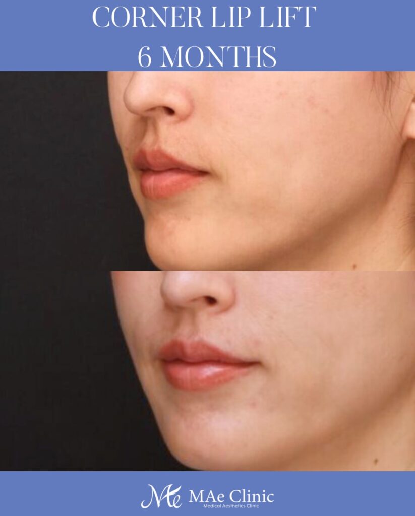 口角挙上 木下恵里沙医師症例