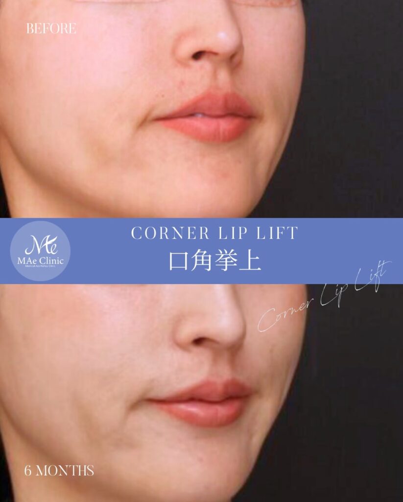 口角挙上
木下恵里沙医師症例