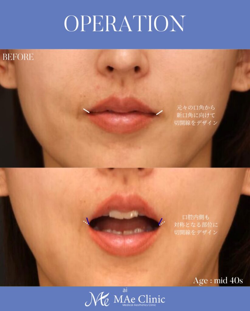 口角挙上 木下恵里沙医師症例