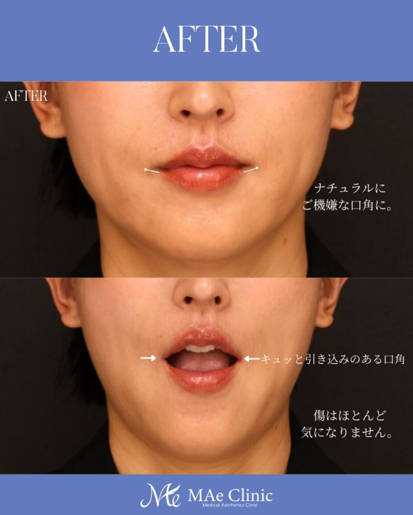 口角挙上 木下恵里沙医師症例