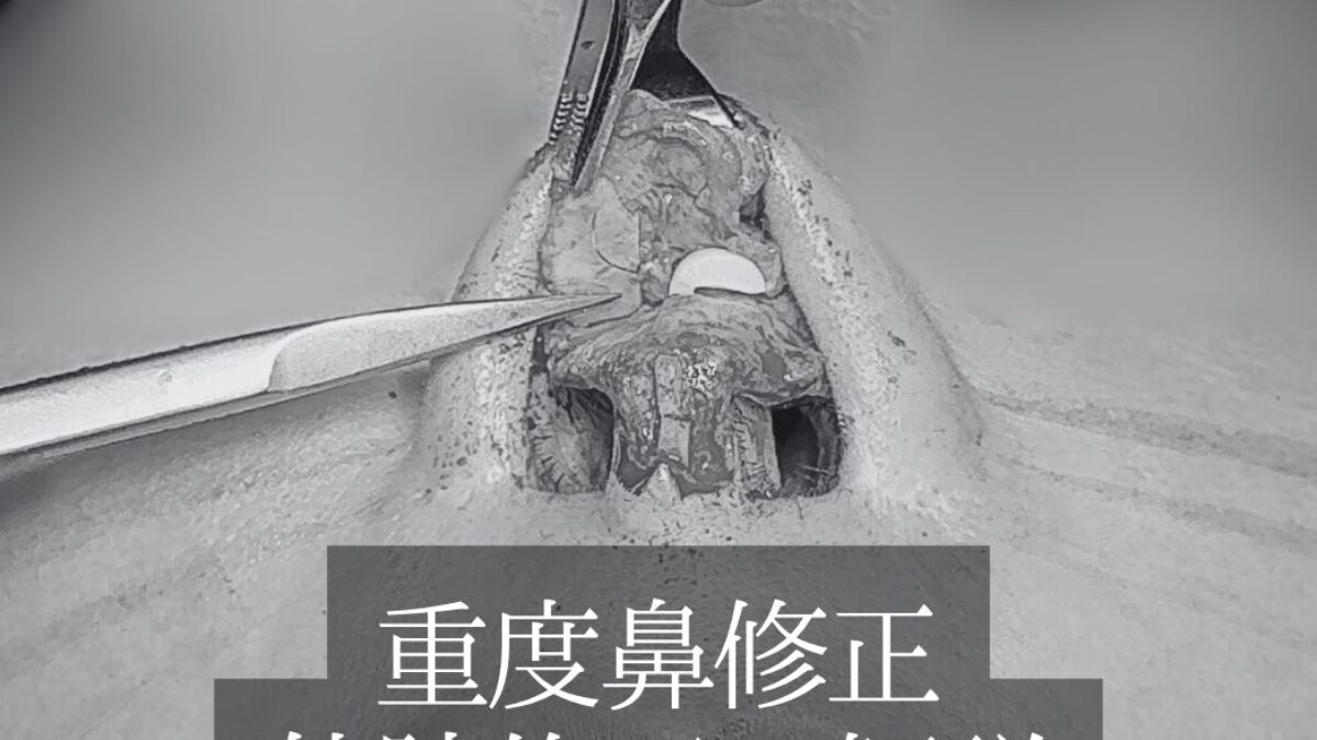 鼻の重度修正手術｜プロテーゼ・耳軟骨・鼻中隔延長が混在した複合症例