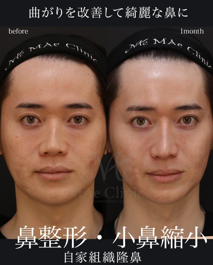 鼻中隔延長（肋軟骨）
鼻尖形成
鼻尖軟骨移植
自家組織隆鼻
望月正人医師症例
