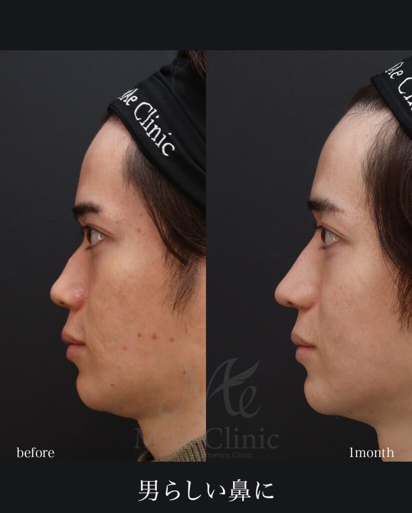 鼻中隔延長（肋軟骨） 鼻尖形成 鼻尖軟骨移植 自家組織隆鼻 望月正人医師症例