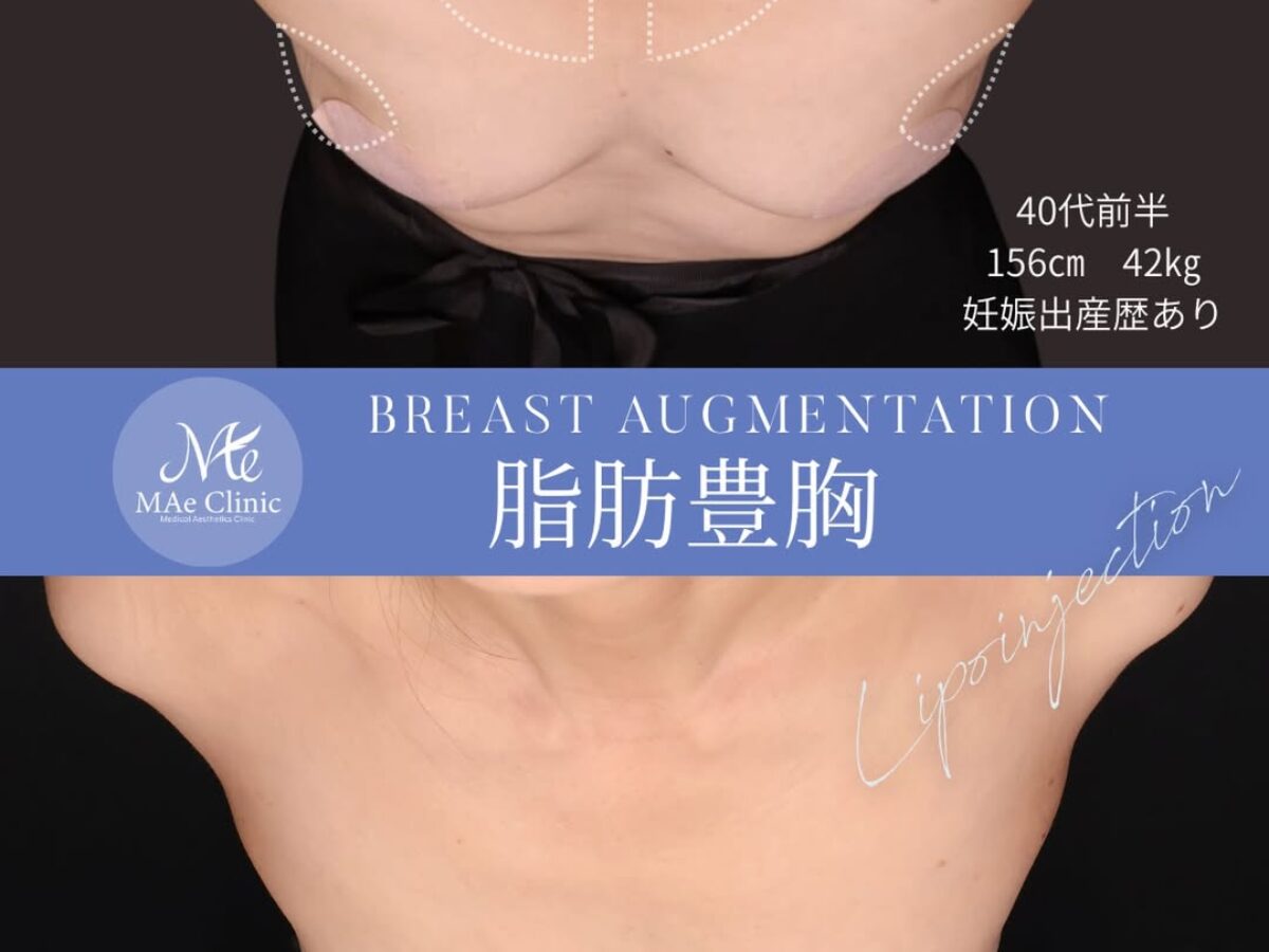 【未使用】脂肪豊胸後 専用下着CHERIAGE Mサイズ 2026040604-1200x900.jpg