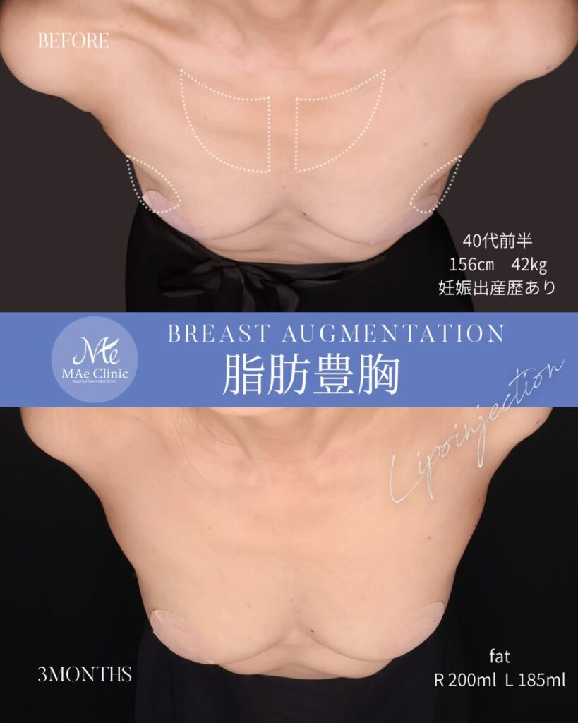 コンデンスリッチ脂肪豊胸 採取部位：大腿後面 処理方法：コンデンスリッチ法 注入量：右200ml・左185ml（Total 385ml） 木下恵里沙医師症例