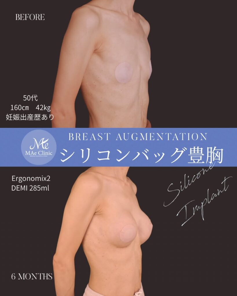 シリコンバッグ豊胸（Motiva Ergonomix2） サイズ：両側285ml 木下恵里沙医師シリコンバッグ豊胸症例