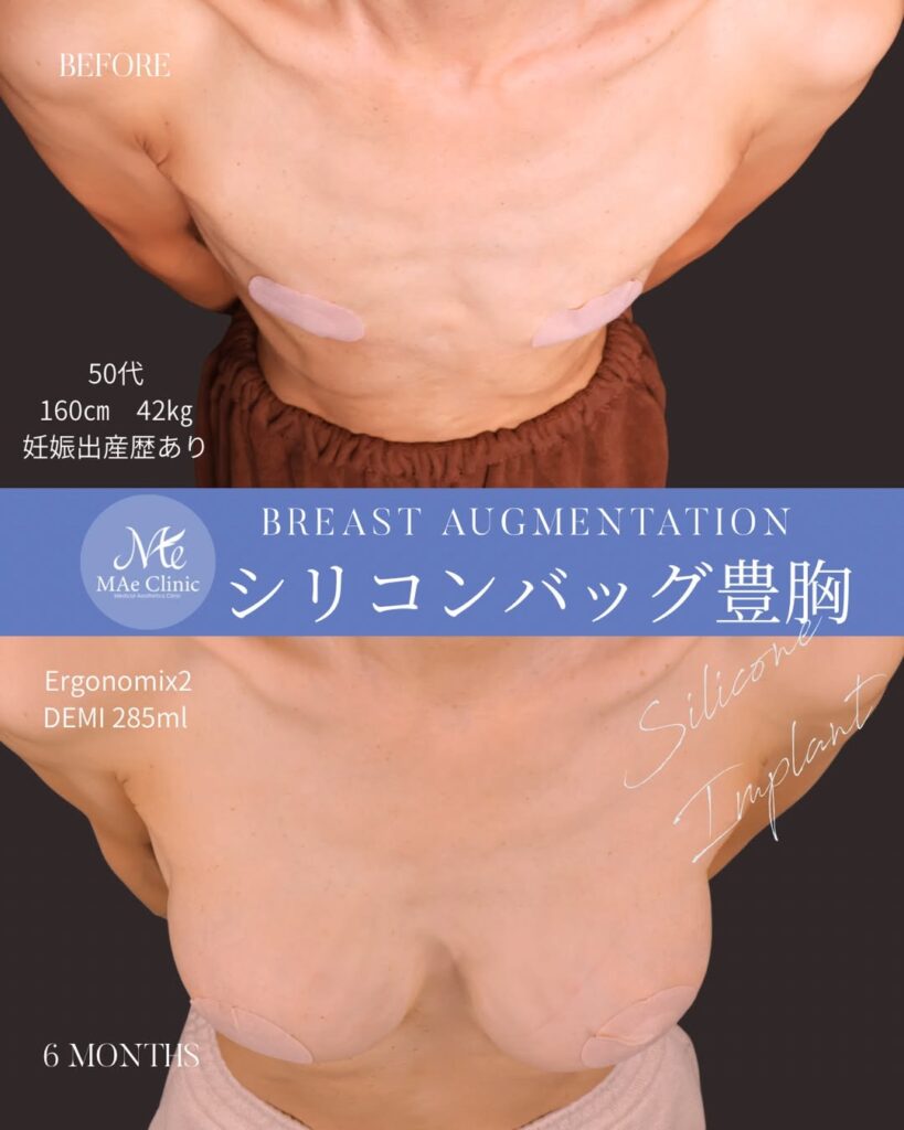 シリコンバッグ豊胸(Motiva Ergonomix2) サイズ:両側285ml 木下恵里沙医師シリコンバッグ豊胸症例