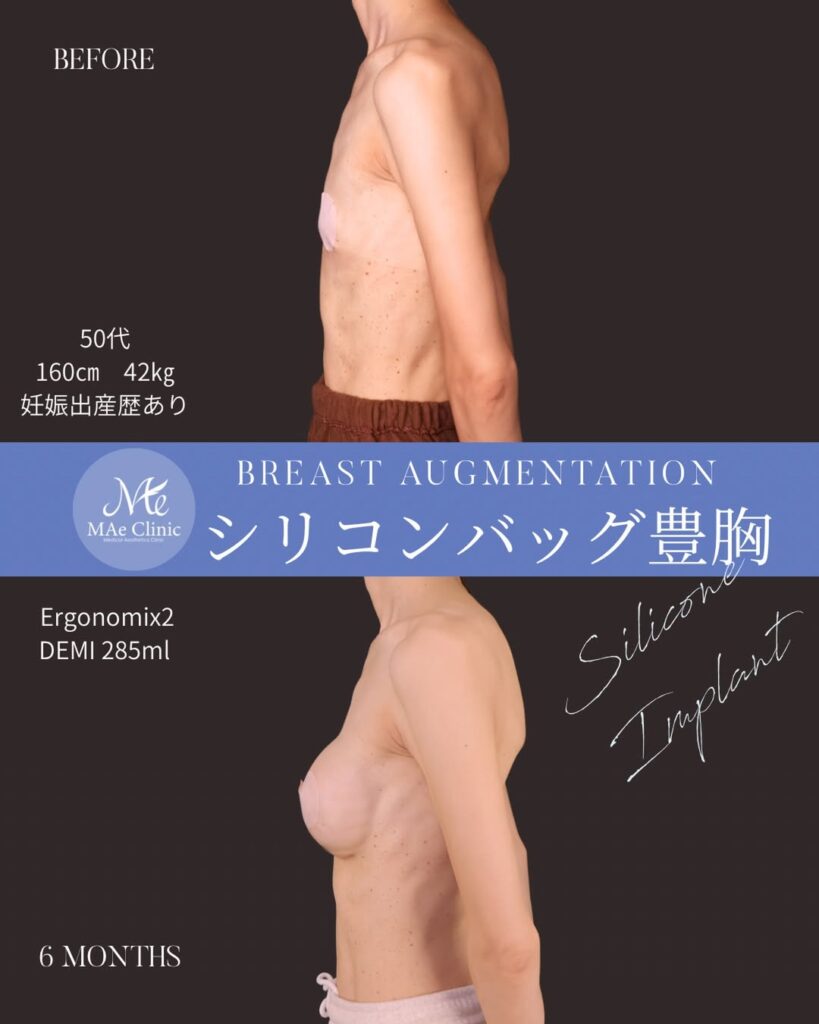 シリコンバッグ豊胸(Motiva Ergonomix2) サイズ:両側285ml 木下恵里沙医師シリコンバッグ豊胸症例